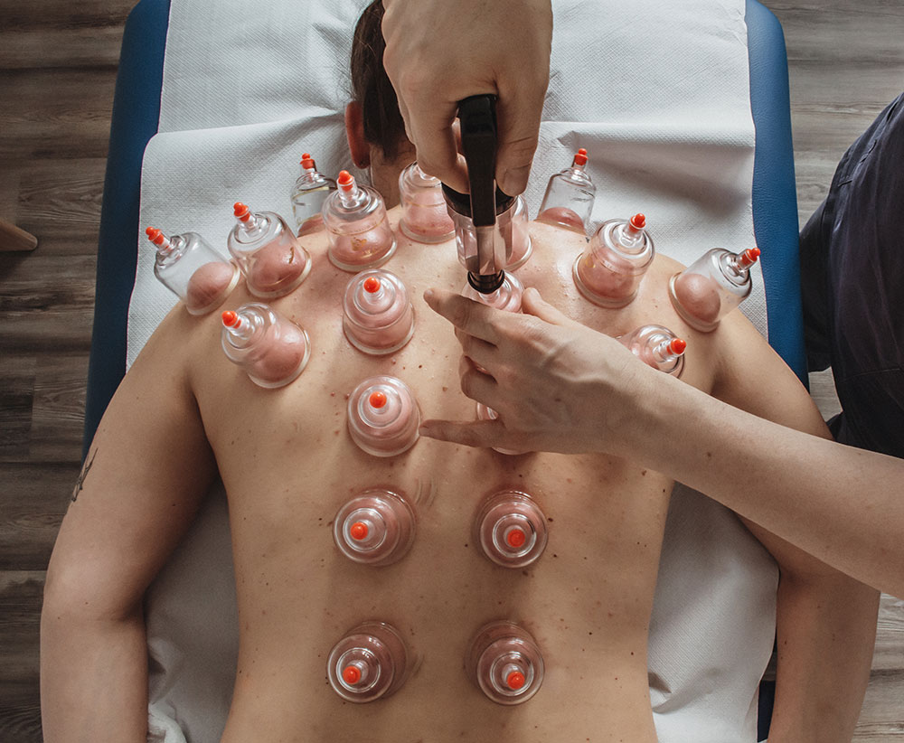 Cupping Therapy: